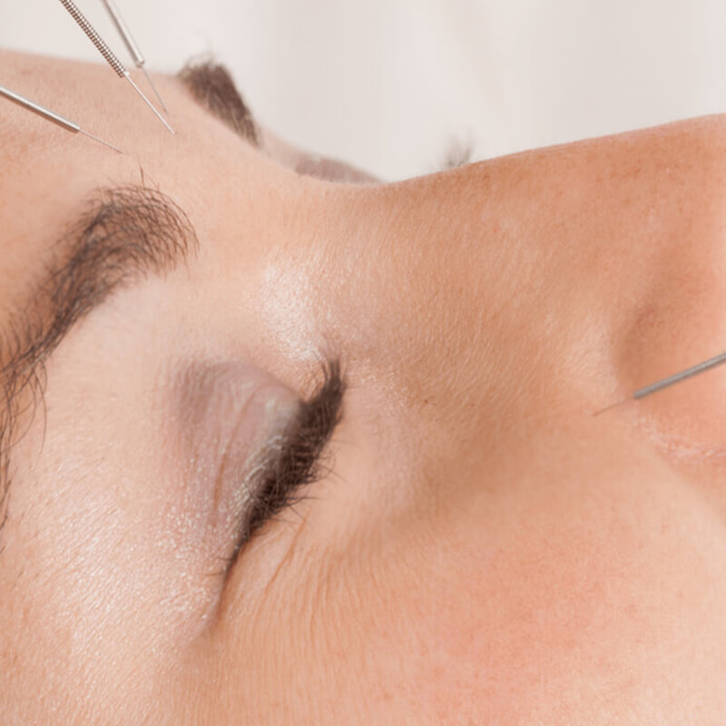 acupuntura-facial-isasi